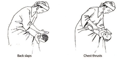Resuscitation method to overcome choking for infants