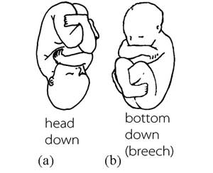 (a) Cephalic presentation (head down). (b) Breech presentation (bottom down)
