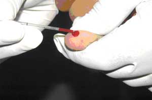 A finger has been pin-pricked and is being squeezed to get a droplet of blood to be tested