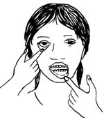 A woman pulling her bottom lip down and her lower eyelid to check for paleness.