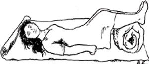 A woman who is haemorrhaging is lying on her back. A rolled up blanket has been placed beneath her legs to elevate them.