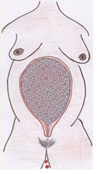 How a molar pregnancy presents itself in the womb.