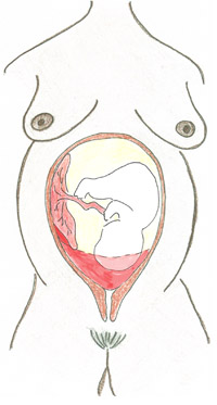 How a placental abruption appears in the womb.