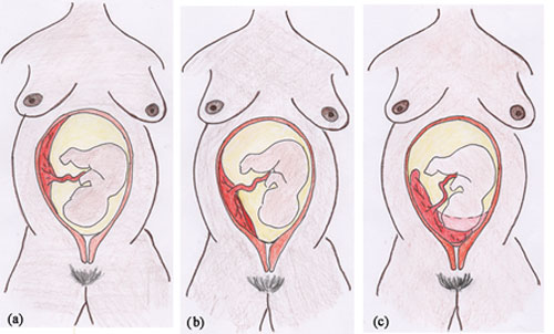 Three diagrams of the three classifications of placenta previa showing how it appears in the womb.