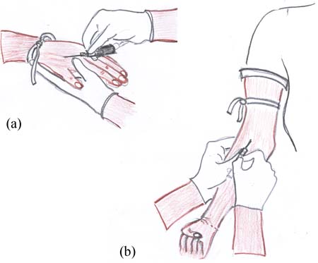 Two images showing hoe to insert a cannula into a vein in the patients hand and in the forearm.