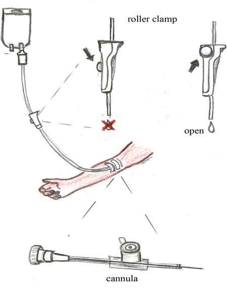 The roller clamp in its closed and opened position and how it is attached to the cannula going into the forearm. A close up of the cannula.