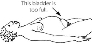 A pregnant woman is lying naked on her back. Her bladder is too full and is distended above her pubic bone.