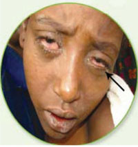 A person with conjunctivitis.