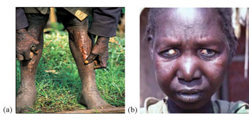 Effects of onchocerciasis