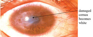 Corneal opacity, damaged cornea becomes white