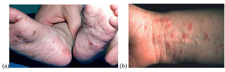 Scabies sores on feet and wrist