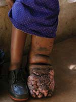 A woman with 'mossy foot' disease.